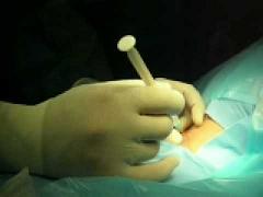 Cirugía ambulatoria en casos de columna vertebral en el Manuel Ascunce