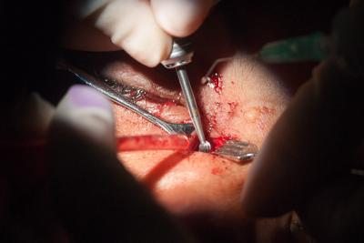 En Camagüey: Técnica quirúrgica realizada por primera vez solo por Oftalmólogos
